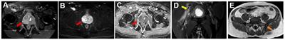 Case report: Systemic tuberculosis with prostate involvement mimicking prostate cancer with multiple metastases on 18F-FDG and 18F-PSMA PET/CT